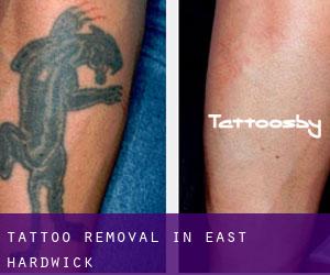 Tattoo Removal in East Hardwick