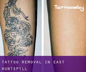 Tattoo Removal in East Huntspill