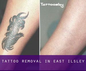 Tattoo Removal in East Ilsley