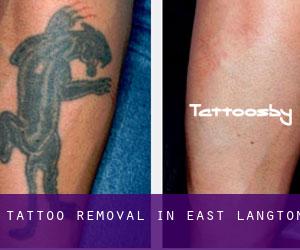 Tattoo Removal in East Langton