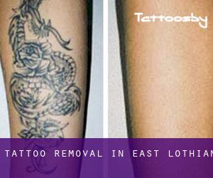 Tattoo Removal in East Lothian