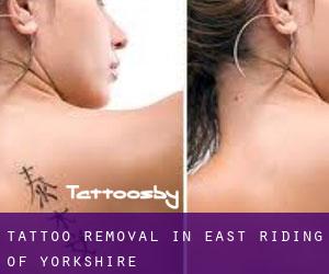 Tattoo Removal in East Riding of Yorkshire
