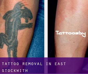 Tattoo Removal in East Stockwith