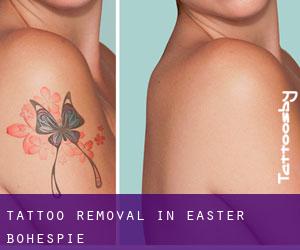 Tattoo Removal in Easter Bohespie