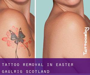 Tattoo Removal in Easter Gaulrig (Scotland)