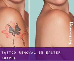Tattoo Removal in Easter Quarff