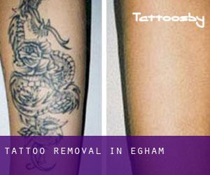 Tattoo Removal in Egham