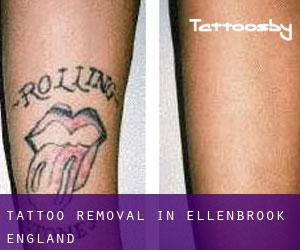 Tattoo Removal in Ellenbrook (England)