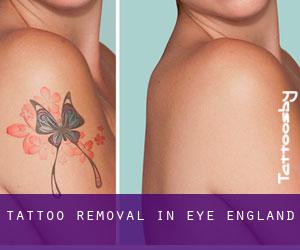 Tattoo Removal in Eye (England)