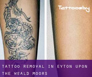 Tattoo Removal in Eyton upon the Weald Moors
