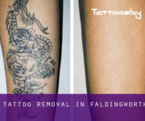 Tattoo Removal in Faldingworth