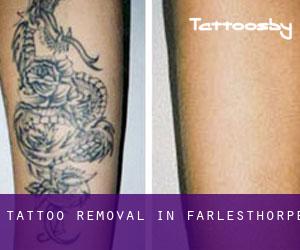 Tattoo Removal in Farlesthorpe