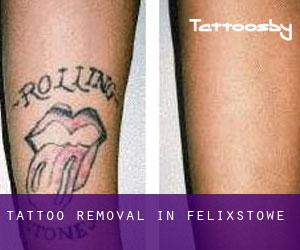 Tattoo Removal in Felixstowe