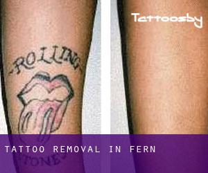 Tattoo Removal in Fern