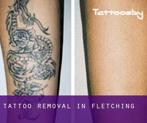 Tattoo Removal in Fletching