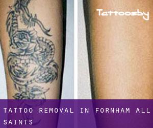 Tattoo Removal in Fornham All Saints