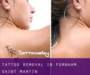 Tattoo Removal in Fornham Saint Martin