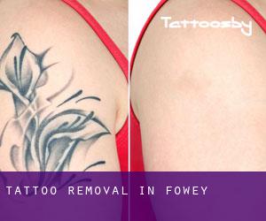 Tattoo Removal in Fowey