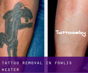 Tattoo Removal in Fowlis Wester