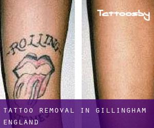 Tattoo Removal in Gillingham (England)