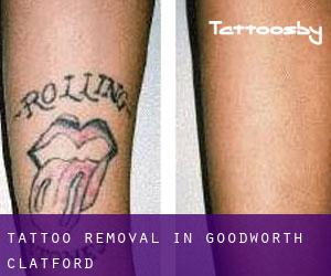 Tattoo Removal in Goodworth Clatford