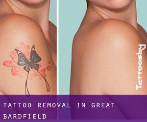 Tattoo Removal in Great Bardfield