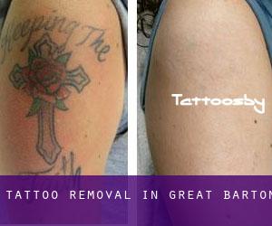 Tattoo Removal in Great Barton