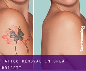 Tattoo Removal in Great Bricett
