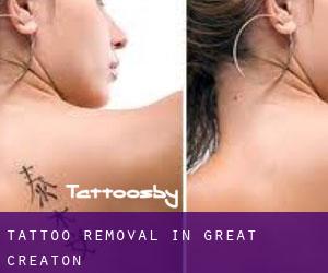 Tattoo Removal in Great Creaton