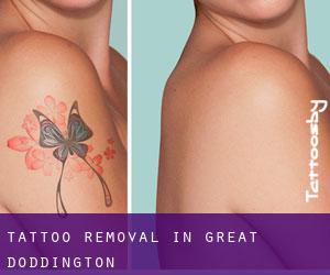 Tattoo Removal in Great Doddington