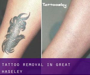 Tattoo Removal in Great Haseley