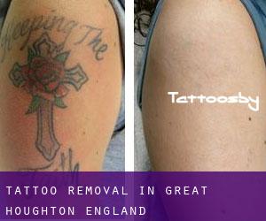 Tattoo Removal in Great Houghton (England)