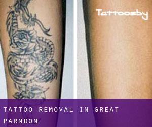 Tattoo Removal in Great Parndon