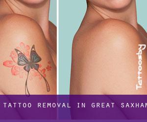 Tattoo Removal in Great Saxham