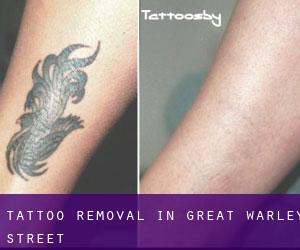 Tattoo Removal in Great Warley Street