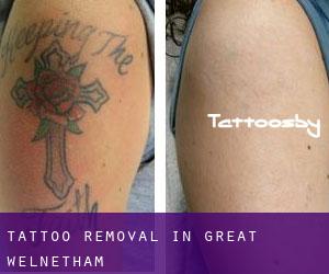 Tattoo Removal in Great Welnetham