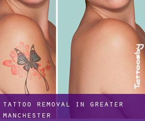 Tattoo Removal in Greater Manchester