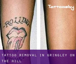Tattoo Removal in Gringley on the Hill