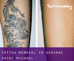 Tattoo Removal in Gussage Saint Michael