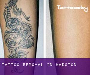 Tattoo Removal in Hadston