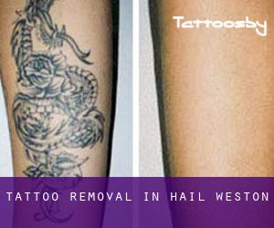 Tattoo Removal in Hail Weston