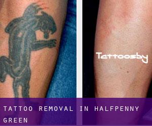 Tattoo Removal in Halfpenny Green