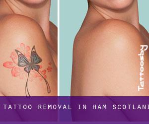 Tattoo Removal in Ham (Scotland)