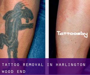 Tattoo Removal in Harlington Wood End