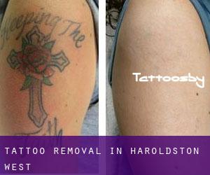 Tattoo Removal in Haroldston West
