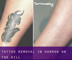 Tattoo Removal in Harrow on the Hill
