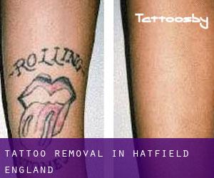 Tattoo Removal in Hatfield (England)