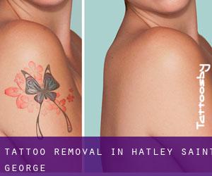Tattoo Removal in Hatley Saint George
