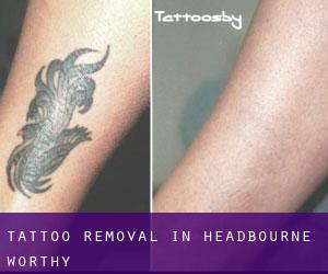Tattoo Removal in Headbourne Worthy