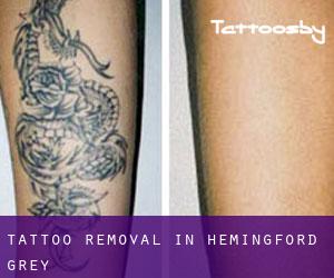 Tattoo Removal in Hemingford Grey